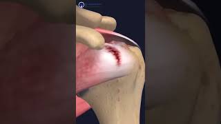 REVERSE shoulder replacement SURGERY  Dr Sharath Babu Nilagiri  shouldersurgery shoulderpain [upl. by Herby]