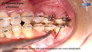 Molar uprighting spring [upl. by Storer]