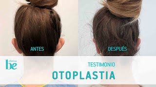 Otoplastia o cirugía de orejas Mi experiencia y testimonio  VICTORIA RUIZ  Clínicas Be [upl. by Lam]