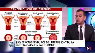 Comment dépister et prévenir le cancer du col de lutérus [upl. by Alejna789]