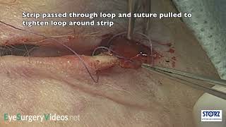 Lateral tarsal strip alternative suturing technique [upl. by Haraj]