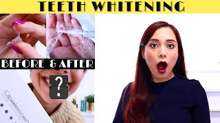 TEETH WHITENING BEFORE amp AFTER  OPALESCENCE 16 AT HOME KİT  HOW TO USE  SENSİTİVİTİES 🥴 [upl. by Sierra639]