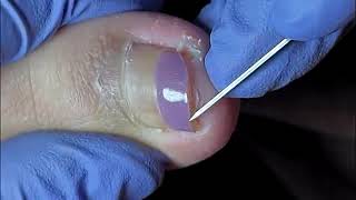 DIY Ingrown Toenail Removal  How to Safely Cut Ingrown Toenails at Home [upl. by Uella]