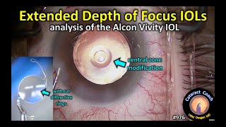 Extended Depth of Focus IOLs EDOF Lens for cataract surgery  Alcon Vivity [upl. by Cosma]