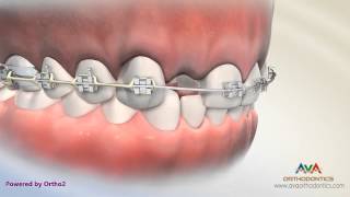 Orthodontic amp Restorative Treatment for Missing Lateral Incisor  Different Options [upl. by Ellis]