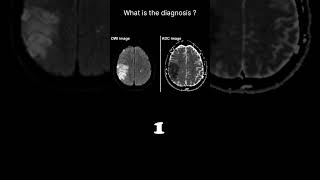 Diffusion weighted imaging – Infarct brain Quiz 19 radiologychannel007 [upl. by Yenwat]