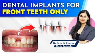 Dental Implants for FRONT TEETH only Dr Srishti Bhatia implants dentist newteeth [upl. by Shelbi673]