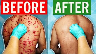 How To Cure Shingles in 2024 [upl. by Elbas]