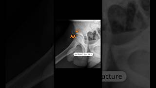 right anterior inferior iliac spine avulsion fracture xray shortsfeed [upl. by Neelrahc]