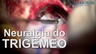 Cirurgia Tratamento da NEURALGIA DO TRIGÊMEO [upl. by Cozmo902]