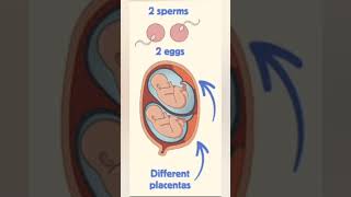 twins pregnancy baby conceive pregnancysigns viral [upl. by Leary]