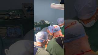 Hepatectomy I Advanced GI SURGERY I Liver Team I Surat I India [upl. by Amrita]