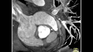 Cardiac Circumflex arises off RCA right coronary artery 3 of 3 [upl. by Finah537]