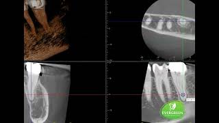 Root Canal Treatment  Tooth 18 CShaped Canal Existing Crown 3D CBCT at Evergreen Endodontics [upl. by Ecnarf246]