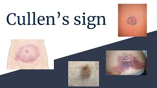 Understanding Cullens Sign  Clinical Significance and Causes [upl. by Esilrahc]