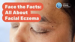 Webinar Face the Facts—All About Facial Eczema [upl. by Mirilla]