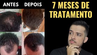 CALVÃCIE MASCULINA RESULTADO DE APENAS 7 MESES Queda de cabelo  Cabelo caindo muito [upl. by Devehcoy844]