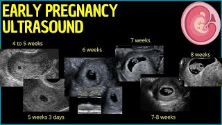 Early Pregnancy Ultrasound A Deep Dive into First Trimester Insights pregnancyultrasound [upl. by Wilen445]