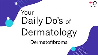 Dermatofibroma  Daily Dos of Dermatology [upl. by Francie]