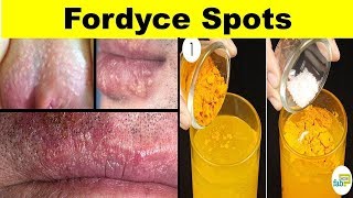 How to get ride Fordyce Spots  Treatments with natural Home Remedies 2018 [upl. by Gertie745]