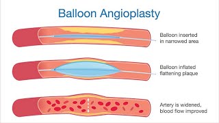 Balloon Angioplasty Surgical procedure  Definition Types Indications Techniques Advantages [upl. by Aid]