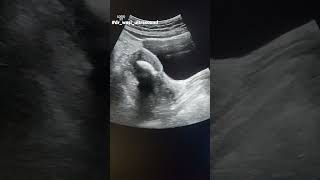 Endometrial calcification osseus metaplasia drwasiultrasound [upl. by Traci]