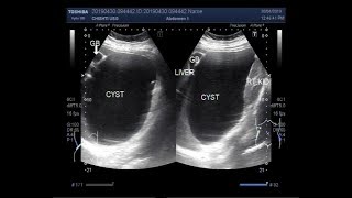 Ultrasound Video showing a large Hepatic hydatid Cyst [upl. by Nivrag]