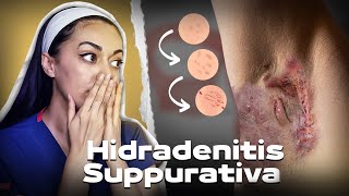 Painful Boils Under Armpits and Down There Could It Be Hidradenitis Suppurativa [upl. by Jacquenette]