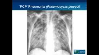 Opportunistic Infections I [upl. by Denae]