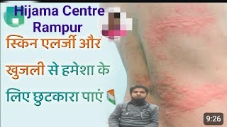 Hijama Centre Rampur [upl. by Aivilys]