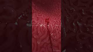 Bleeding gastric ulcer 3d animation anatomy meded [upl. by Davison119]