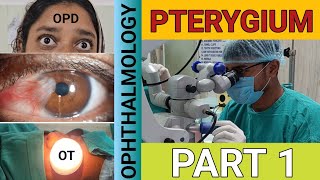 PTERYGIUM  PART 1  THEORY  OPHTHALMOLOGY  EDUCATIONAL VIDEO [upl. by Sibella]