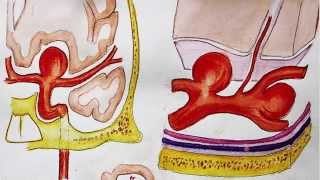 Understanding Brain aneurysm and endovascular coiling [upl. by Letsyrc]