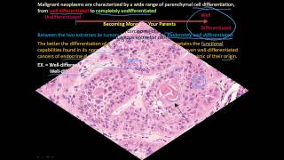 113P How to tell a benign and malignant tumor apart Differentiation and Anaplasia [upl. by Ezitram]