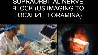 ULTRASOUND GUIDED SUPRAORBITAL NERVE BLOCK ULTRASOUND IMAGING TO LOCALIZE FORAMINA [upl. by Ajim307]