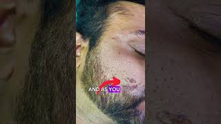 Scar revision  scar removal panaceaplasticsurgery scars scarremoval [upl. by Roxy893]