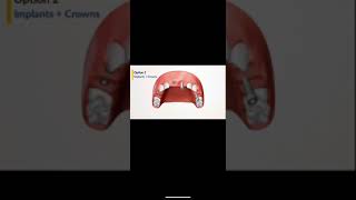 Bridge vs implants vs partial dentures  SIOS has revolutionized the system [upl. by Dupuis]