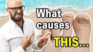 What Causes Toenails to Turn Yellow [upl. by Herb]