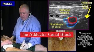 The Adductor canal block [upl. by Nnyleak]