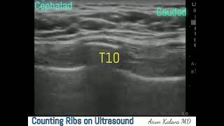 Counting Ribs on Ultrasound [upl. by Ahseyd]