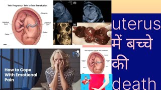 Fetal death inside uterusFetal demiseबच्चे की धड़कन गर्भ में रुक जाना IUFDDr Naima Bano [upl. by Lahcear]