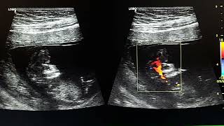 ultrasound case of acrania in 12 weeks fetus [upl. by Ruhl]