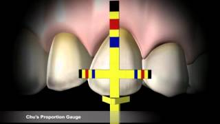 Chus Proportion Gauge [upl. by Garnette]