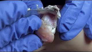 DIY Ingrown Toenail Removal  How to Safely Cut Ingrown Toenails at Home [upl. by Butch]