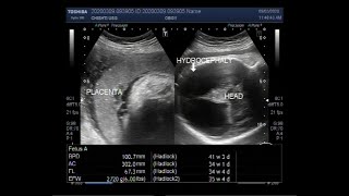 Ultrasound Video showing Fetal hydrocephalus due to ventriculomegaly [upl. by Meghann]