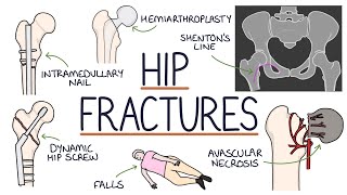 Understanding Hip Fractures and Hip Surgery [upl. by Buchanan]