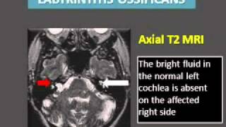 Cochlear ossification Radiological considerations before surgery [upl. by Jeannine]