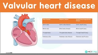 Valvular Heart Diseases Classification Causes Pathophysiology Diagnosis and Treatment [upl. by Tigirb717]