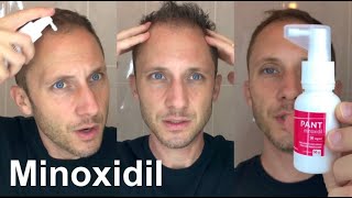 Como Usar Aplicar Minoxidil Tópico para Reverter a Calvicie Hereditaria Queda e Crescer Cabelo Novo [upl. by Ahseinar]