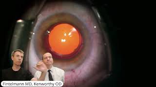 Implantation of light adjustable lens [upl. by Sela]